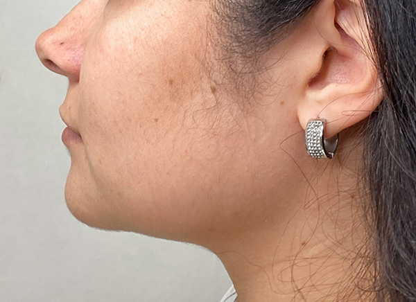 Криолиполиз - после