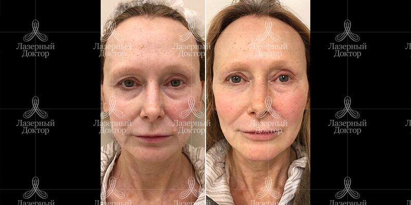 Термаж до и после