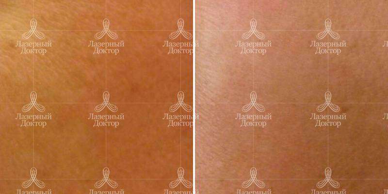 Фото до и после пилинга лица