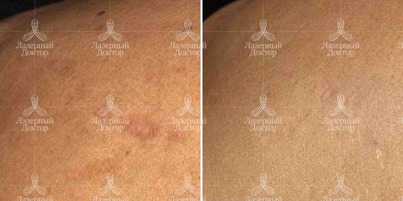 Удаление растяжек лазером (фото до и после)