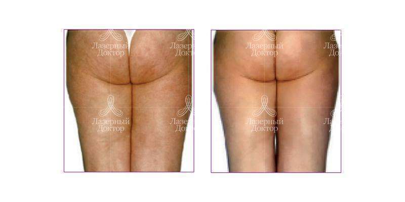 лпг массаж (фото до и после)