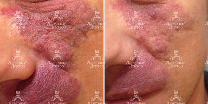 Лазерное удаление гемангиомы на лице