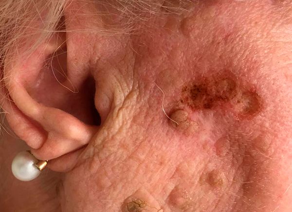 удаление кератомы после