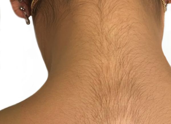 Лазерная эпиляция фото до и после