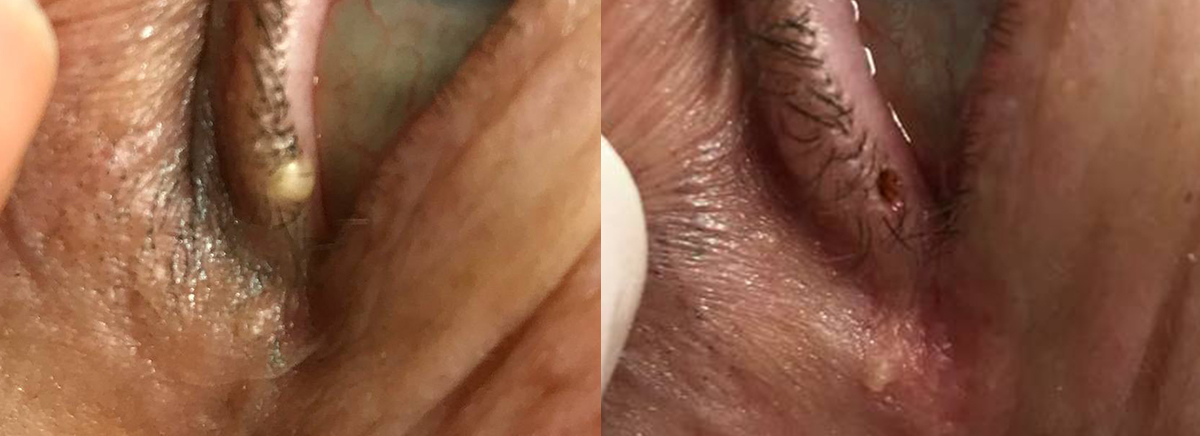 удаление новообразования