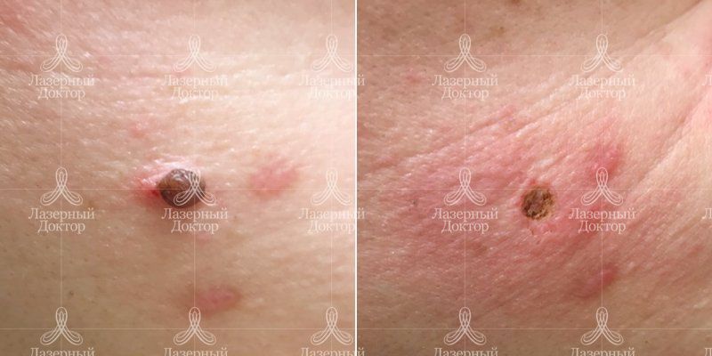 Удаление новообразований