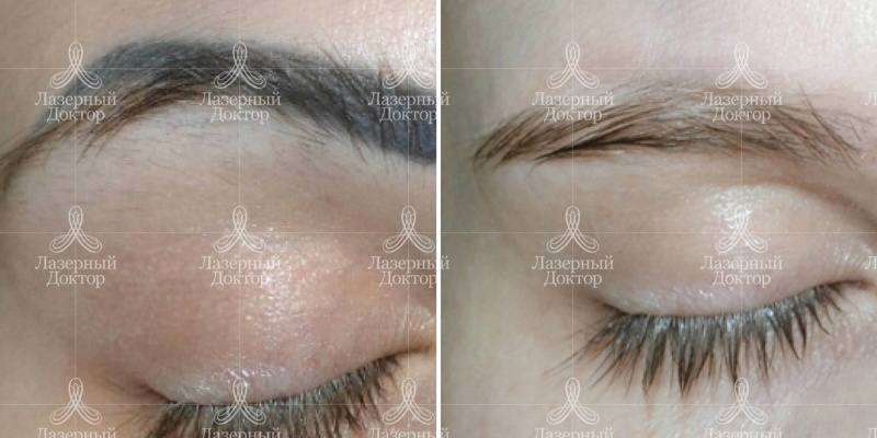 Удаление татуажа лазером: фото до и после