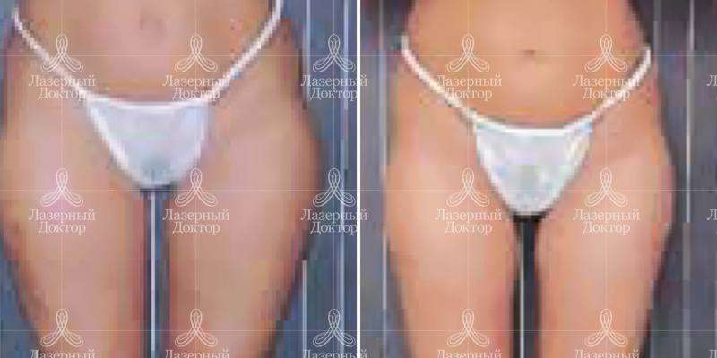 Липолитик Акваликс (фото)