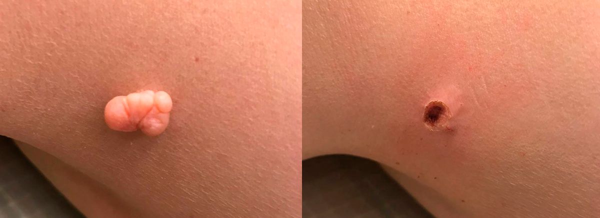 Удаление новообразований кожи 