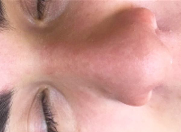 Ультразвуковая чистка лица фото до и после