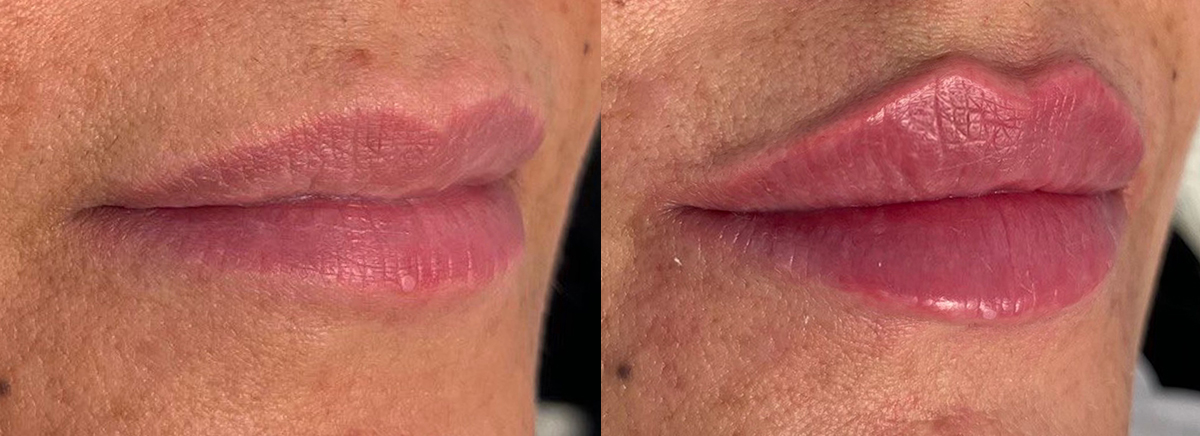 Контурная пластика губ 