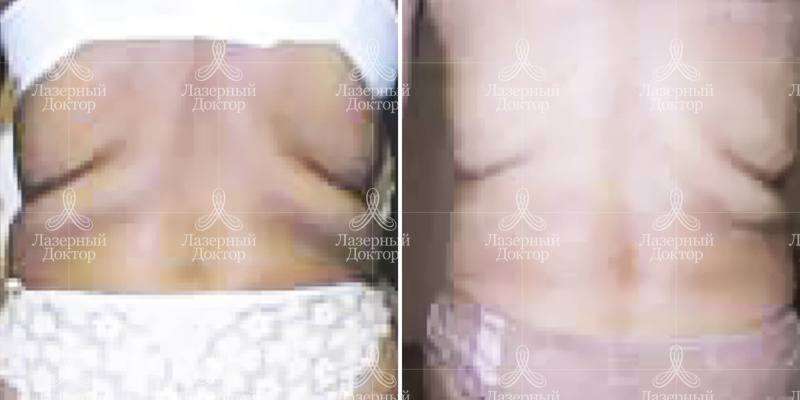 Акваликс (фото до и после)