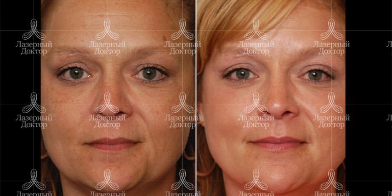 До и После лицо