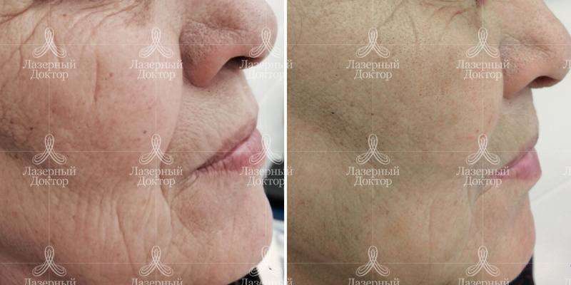 infini 3d волюмизация (микроигольчатый rf-лифтинг)