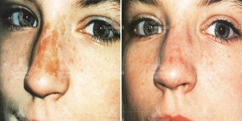 Фотоомоложение Квантум (фото)