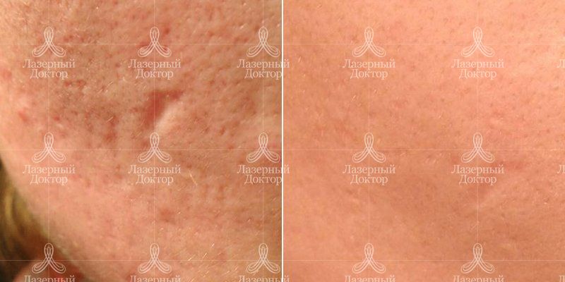 Удаление шрамов