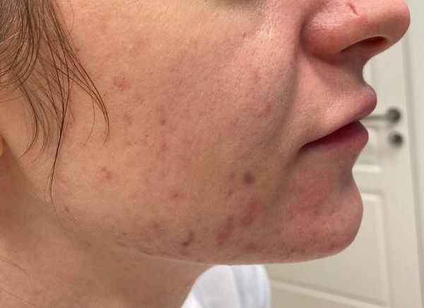 Избавление от акне до