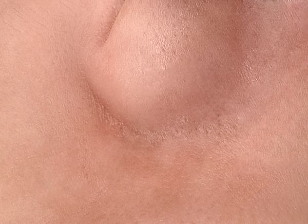 Удаление сосудов фото до и после