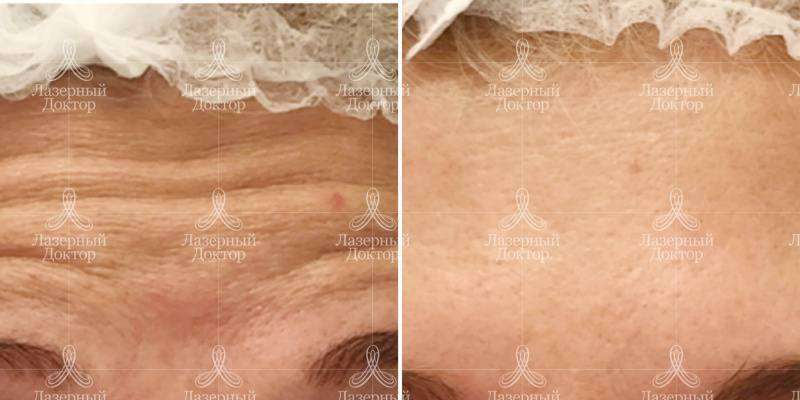 Ботокс в область лба (фото до и после)