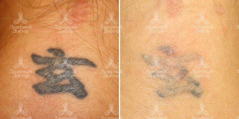 Фото до и после сведения тату с шеи при помощи лазера