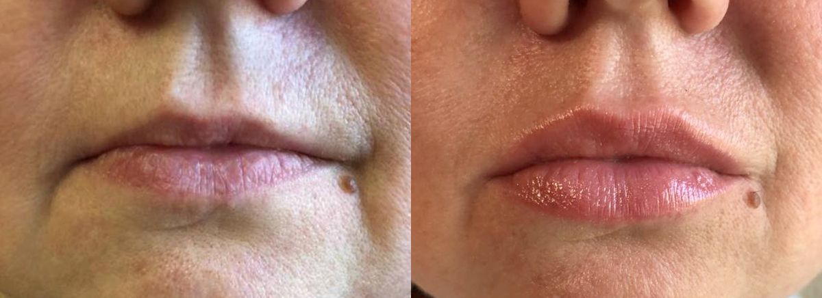 Контурная пластика губ ювидерм 3