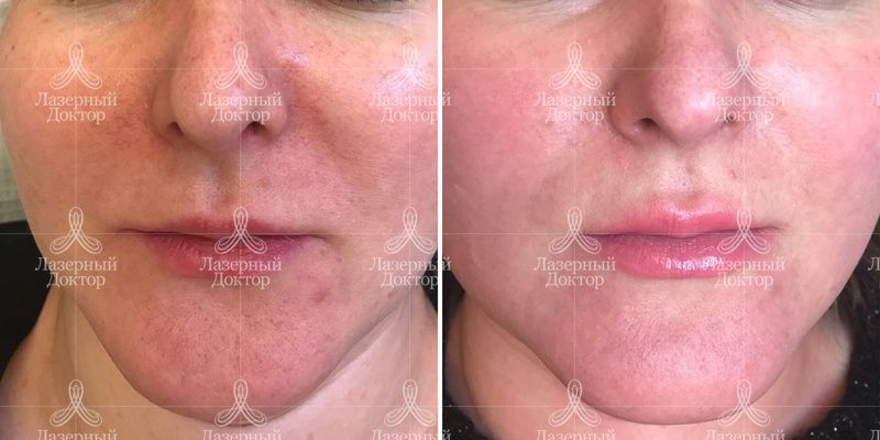 ДОТ-омоложение (до и после)