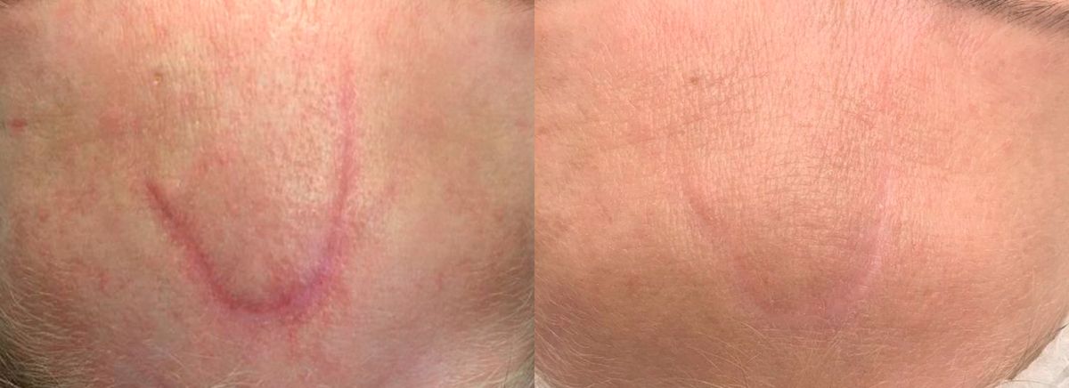 Лазерное удаление шрамов