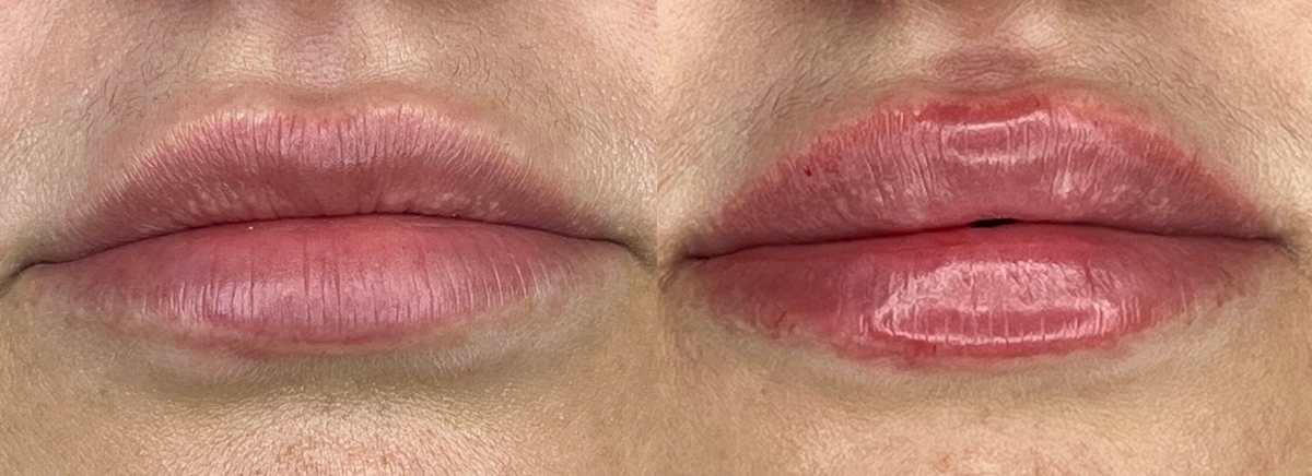 Контурная пластика губ 
