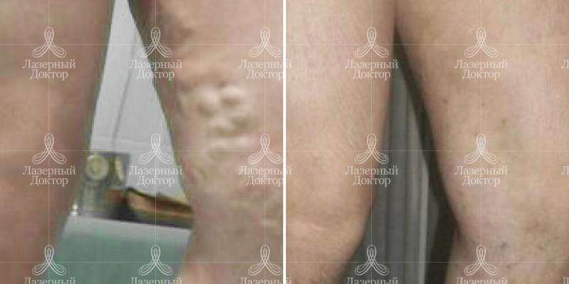 Облитерация вены (фото до и после)