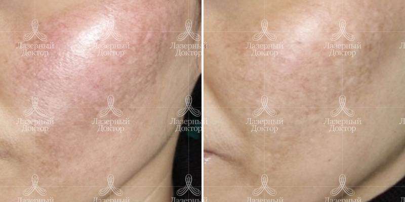 Удаление пигментных пятен лазером