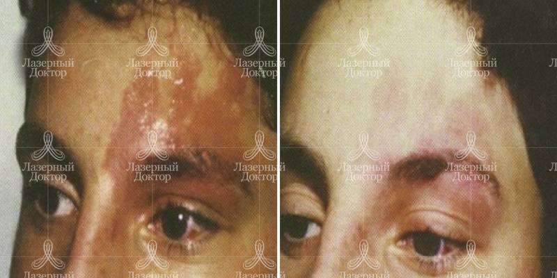 Фотолечение лица (отзывы, фото до и после)