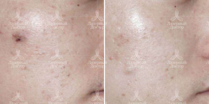 Лечение акне в СПб