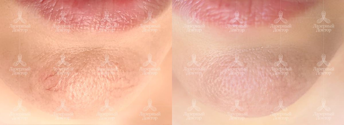 Удаление сосудов фото до и после