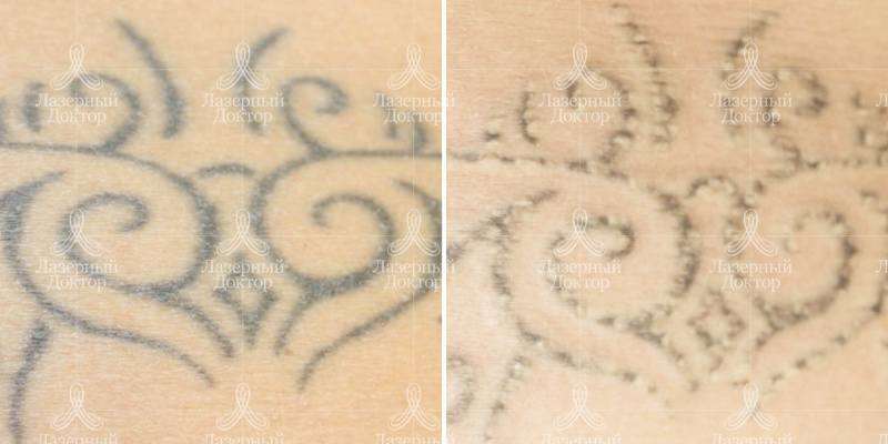 Свести тату лазером (фото)