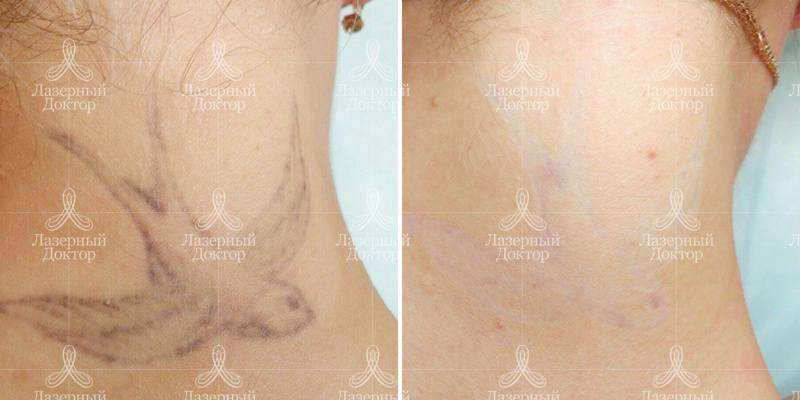 Сведение тату с лица: до и после