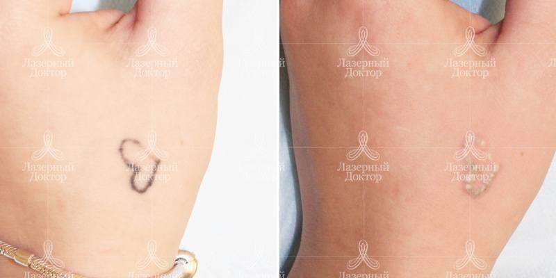 Фото после удаления татуировки лазером