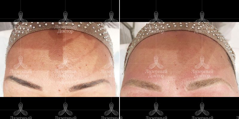 удаление татуажа бровей