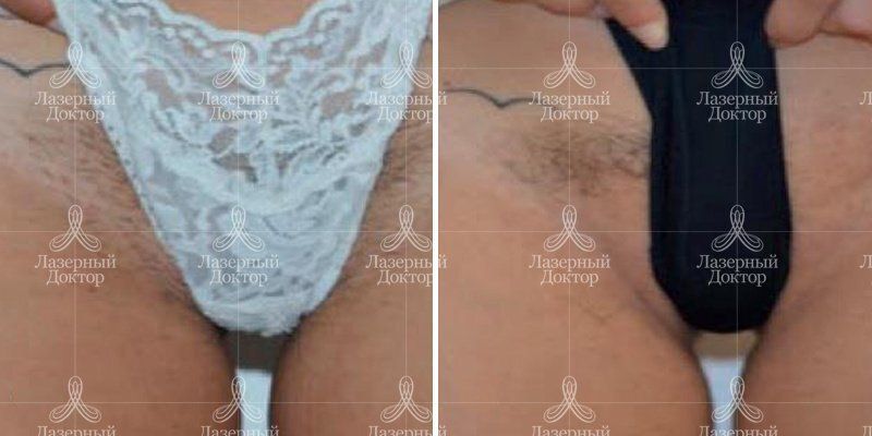 Безболезненная эпиляция зоны бикини (фото до и после процедуры)