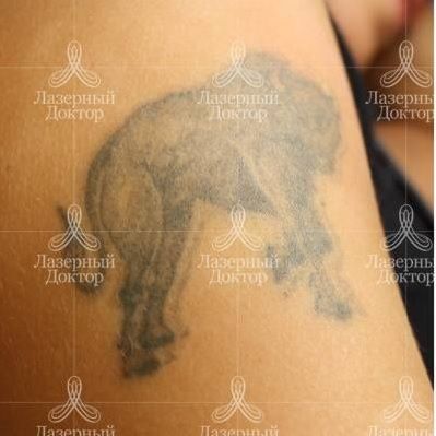 Лазерное удаление татуировки на предплечье до