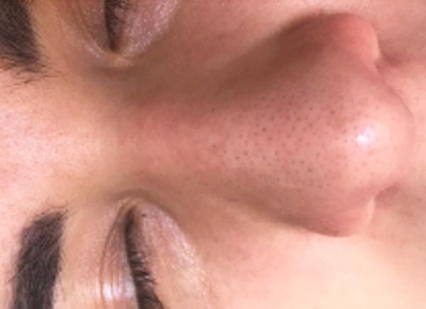 Ультразвуковая чистка лица фото до и после