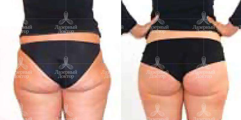 Интралипотерапия - что это такое?(фото)