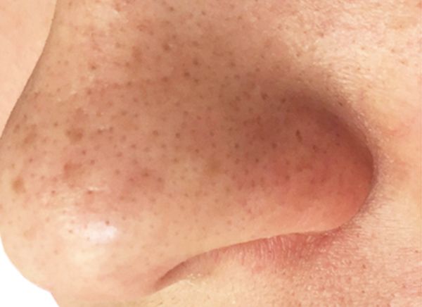 Ультразвуковая чистка лица фото до и после