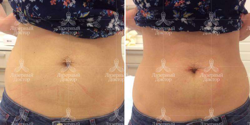 Мезонити для подтяжки живота