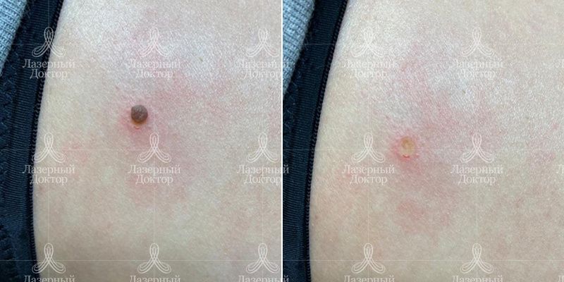 удаление новообразований