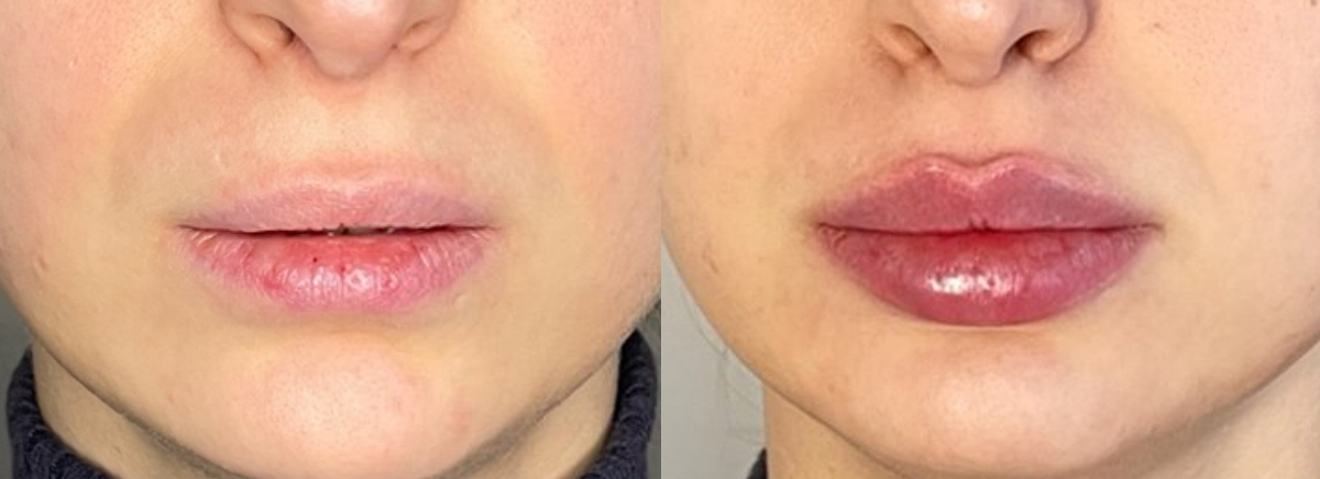 Контурная пластика губ 