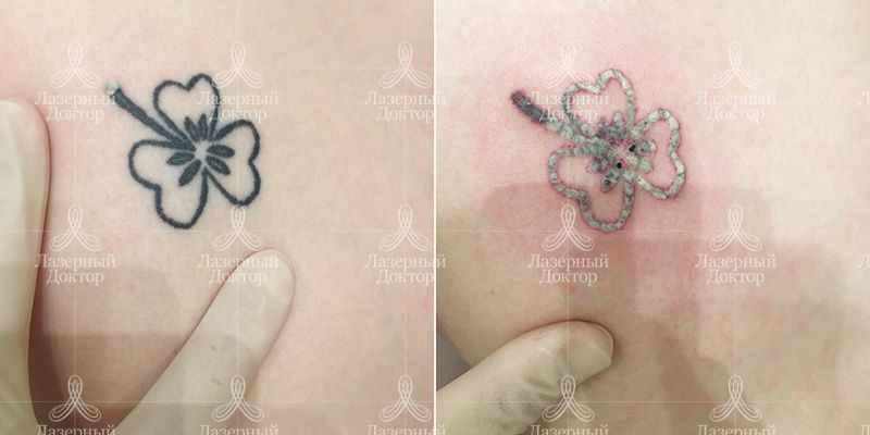 удаление татуировки до и после
