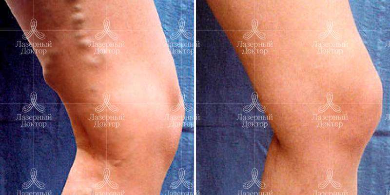 Лазерная облитерация варикозных вен