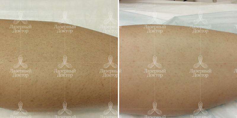 Ноги до и после лазерной эпиляции