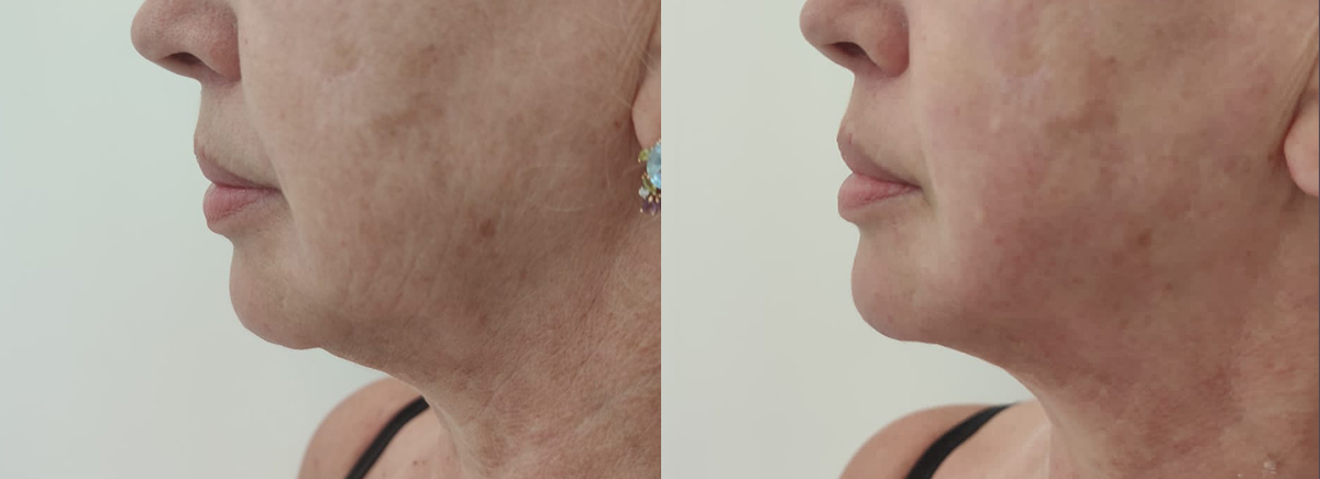 Ультраформер