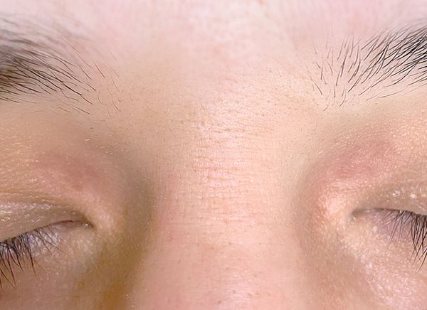 Удаление новообразований фото до и после